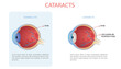 Vector illustration of cataract, cataract is a clouding of the lens of the eye that causes a loss of vision.