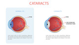 Fototapeta  - Vector illustration of cataract, cataract is a clouding of the lens of the eye that causes a loss of vision.