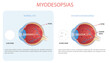 Infographic of a normal eye and myodesopsic eye, also known as floaters or floating bodies.
