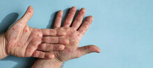 Male Hands With Monkeypox Rash. Patient With MonkeyPox Viral Disease. Close Up Of Painful Rash, Red Spots Blisters On The Skin. Human Palm With Health Problem. Banner, Copy Space. Allergy, Dermatitis