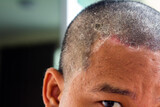 Fototapeta Sawanna - skin disease at the head, Dandruff is a common condition that causes the skin on the scalp to flake