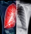 Chest X-ray with Lung 3D rendering  .