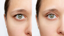 Cropped Shot Of A Young Caucasian Woman's Face With Drooping Upper Eyelid Before And After Blepharoplasty Isolated On A White Background. Result Of Plastic Surgery. Changing The Shape, Cut Of The Eyes