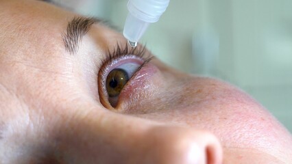 The eyes of a young woman. At the doctor. Instillation into the eyes. Treatment of eye diseases. Cosmetology. Ophthalmologist. Face with fair skin. Close-up. Macro.