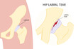 © Pepermpron - Anatomy of hip bone Pain and range of motion groin head tear Treat joint thigh femur injury spurs socket lesion