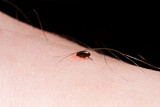Fototapeta  - a flea bites a person sitting on his skin