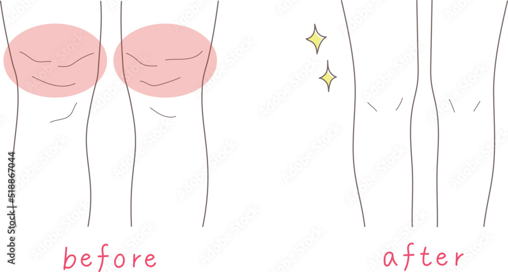 足が太い女性と細い女性のイラスト素材 Stock Vector | Adobe Stock