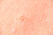 © Alvaro - super macro of almost healed mosquito bite