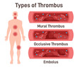 Thrombus types. Arteriosclerosis, infarct, ischemia, thrombosis disease.