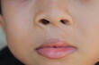 condition of nose and lips after cleft lip surgery in children