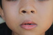 condition of nose and lips after cleft lip surgery in children