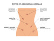 Types of abdominal hernias illustration on isolated background