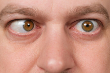 A man with strabismus squints his eyes on a white background.