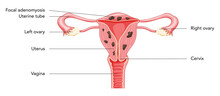 Adenomyosis Focal With Inscriptions, Human Anatomy Female Reproductive Sick System Organs. Structure Of Uterus, Cervix, Ovary, Fallopian Tube In Latin Text. Frontal View In A Cut Vector Illustration