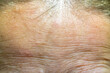 The forehead of a woman with problematic skin