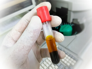 Sticker - Scientist hold test tube with icteric serum for test in laboratory. Hyperbilirubinemia