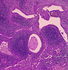 Canvas Print - Infected pre auricular lymph node(biopsy): Warthin Tumor, show lymph node tissue. Also known as papillary cystadenoma lymphomatosum, is a benign cystic tumor.