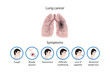 Lung cancer and its symptoms