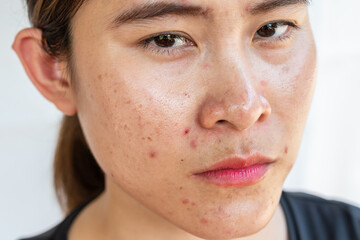 Head shot of Asian woman having problems of acne inflamed on her face.