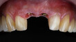 gum cavity with dental implants before installing two ceramic crowns on a black background