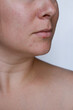 © TatjanaMeininger - close up natural woman bad acne skin with scars
