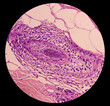 Microscopic image of back skin tissue, Pemphigus vulgaris, smear show suprabasal acantholysis. Intraepidermal vesicles with round acantholytic keratinocytes.