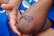 Large, healing scab on the arm of a young boy of african ethnicity