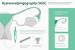 Hysterosalpingography horizontal infographic illustration about infertine healthcare and medical science vector.