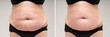 Before and after removing stretch marks from the skin, fat flabby female belly on gray background