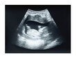 Ultrasound image of fetus in first trimester of singleton pregnancy