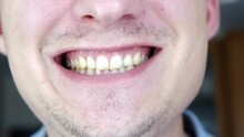 Smiling Young Man With Yellow Teeth.Face Detail Of Guy With Stubble On His Face. Close-up. Waiting For An Appointment With Dentist. Whitening And Oral Care. High Quality 4k Footage 