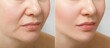A close portrait of an aged woman before and after the facelift procedure. The result of facial rejuvenation and wrinkle smoothing in a cosmetology clinic.