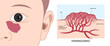 Facial child tumor disorder with Hemangioma on disease