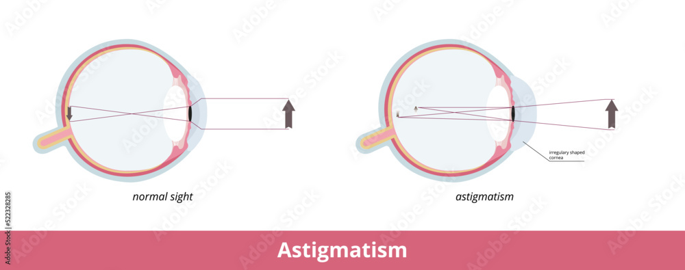 Eye Stigmata Astigmatism. A common imperfection in the curvature of the eye that ...