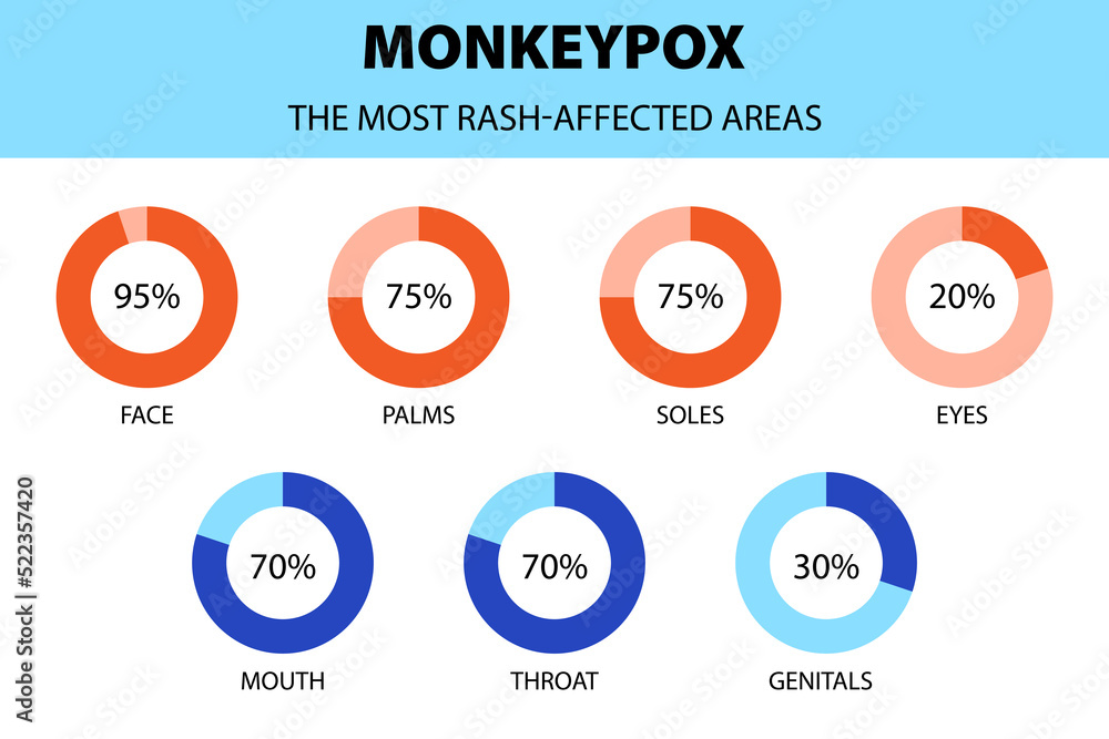 Monkeypox virus infographic. Diagram of the most rash affected areas ...