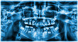 © Angelov - different types of wisdom teeth problems concept. Problem teeth X-ray image scanned