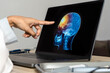 Close up of doctor looking a x-ray of pain in the brain on a laptop. Migraine Headache