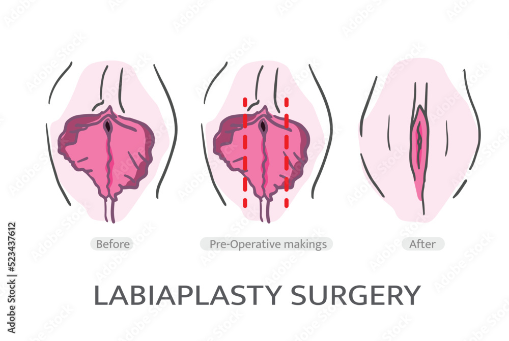 LABIAPLASTY surgery TECHNIQUES. Labiaplasty Vector. Types of female