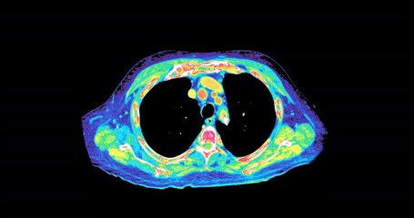 Wall Mural - CT Scan of chest and abdomen in colorful mode or Pet scan. 