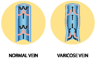 Wall Mural - A comparison of normal vein with varicose vein