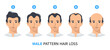 Hair loss stages, androgenetic alopecia male pattern. Steps of baldness vector infographic in a flat style with a man. MPHL
