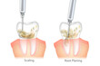 Difference of the Periodontal Scaling and Root Planing. Oral hygiene and conventional periodontal therapy. Medically accurate of human teeth cleaning treatment. Dental scale.