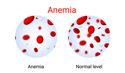 Wall Mural - Anemia problem circulatory iron body diagram background. Anaemia biology blood isolated medical normal icon.