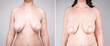 Before and after breastfeeding concept, woman with large saggy breasts after pregnancy and breastfeed