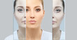 Effects of ageing,Frown scowl lines ,Nasolabial folds,Neck ,Under eye circles,neck lines. Plastic Surgery Results