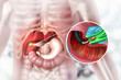 Gallstones removing in the Gallbladder. 3d illustration