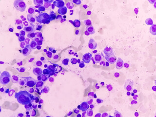 microscopic view of bone marrow slide feature are suggestive multiple myeloma, also known as myeloma