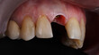 composition of the installed dental implant in the area of the central tooth without a crown, side view