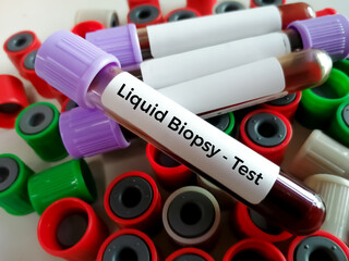 Poster - Blood samples for Liquid biopsy blood test to detect cancer cells or DNA fragments that circulate in the bloodstream, Lung cancer, laboratory background.