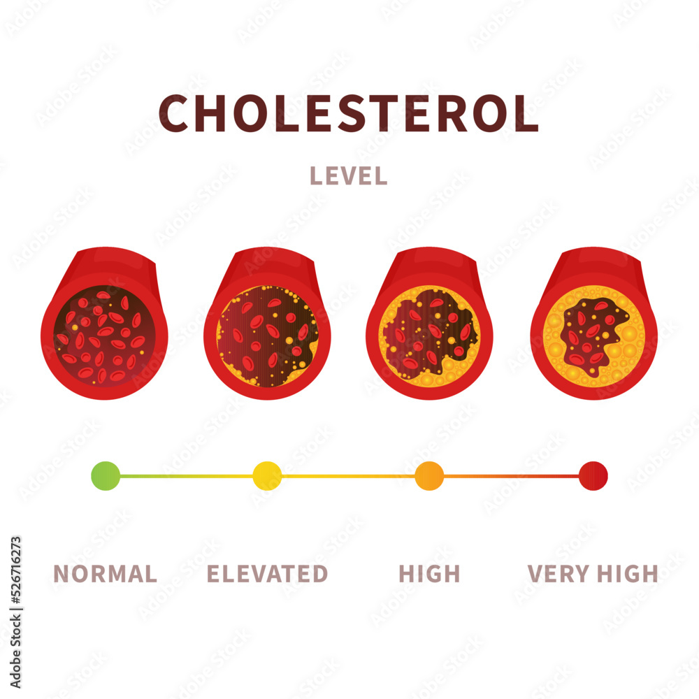 Cholesterol level in blood vessel medical diagram. Meter gauge of ...